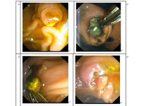 逆行胰胆管造影（ERCP）——从口中取胆管结石